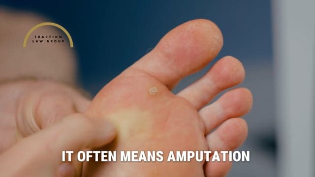 Video thumbnail for Gangrene From Bedsores | Tissue Death Pressure Ulcer Complication